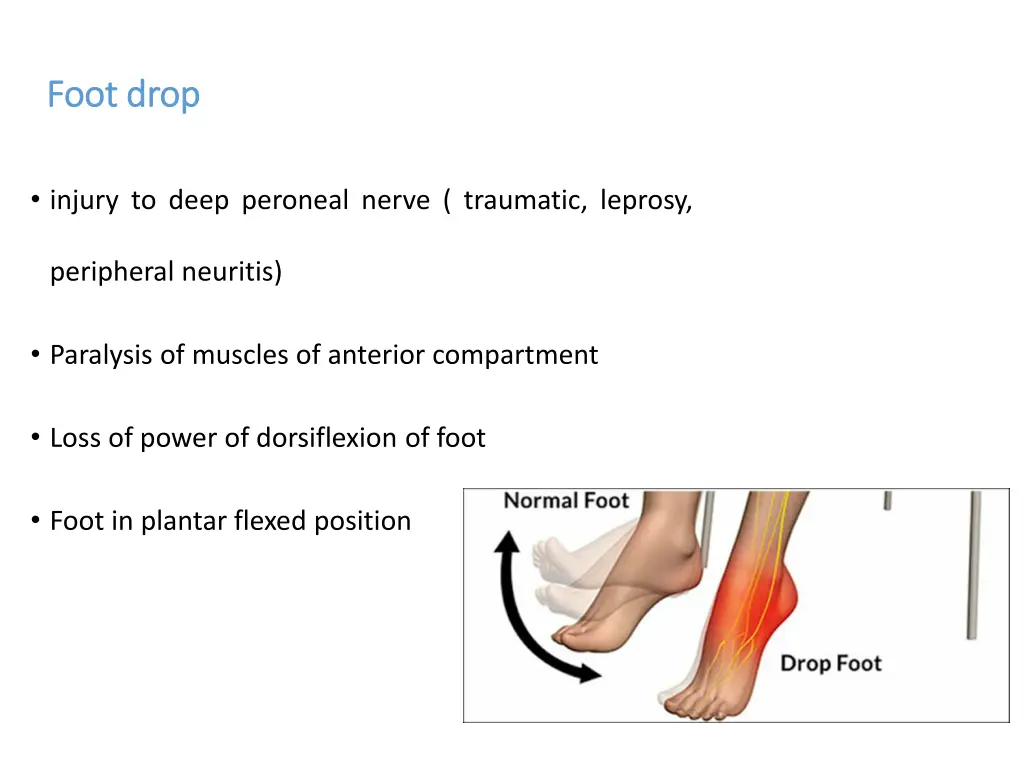 foot drop foot drop