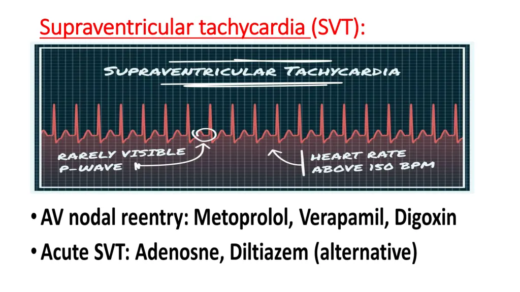 supraventricular tachycardia supraventricular