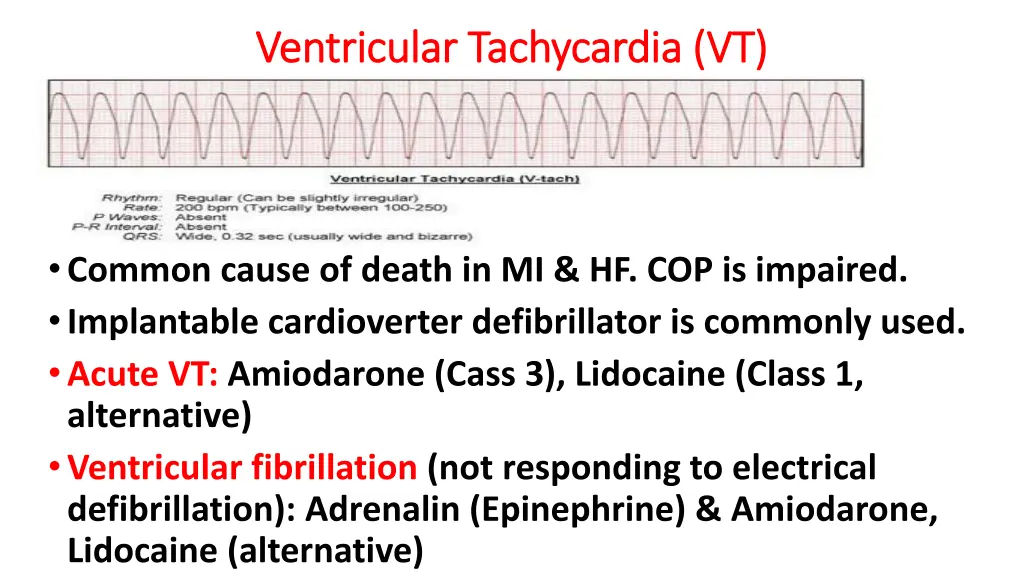 ventricular tachycardia vt ventricular