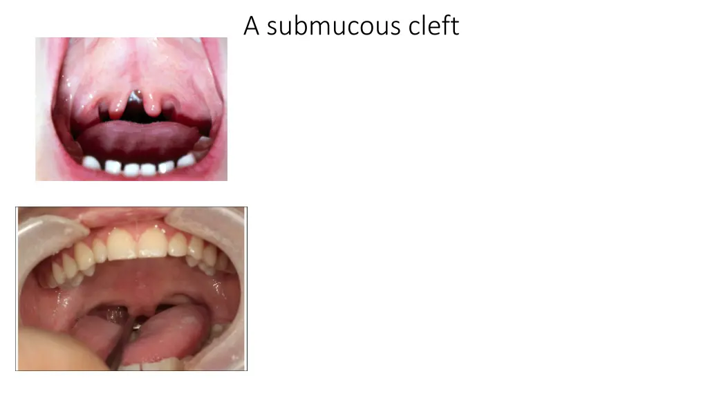 a submucous cleft