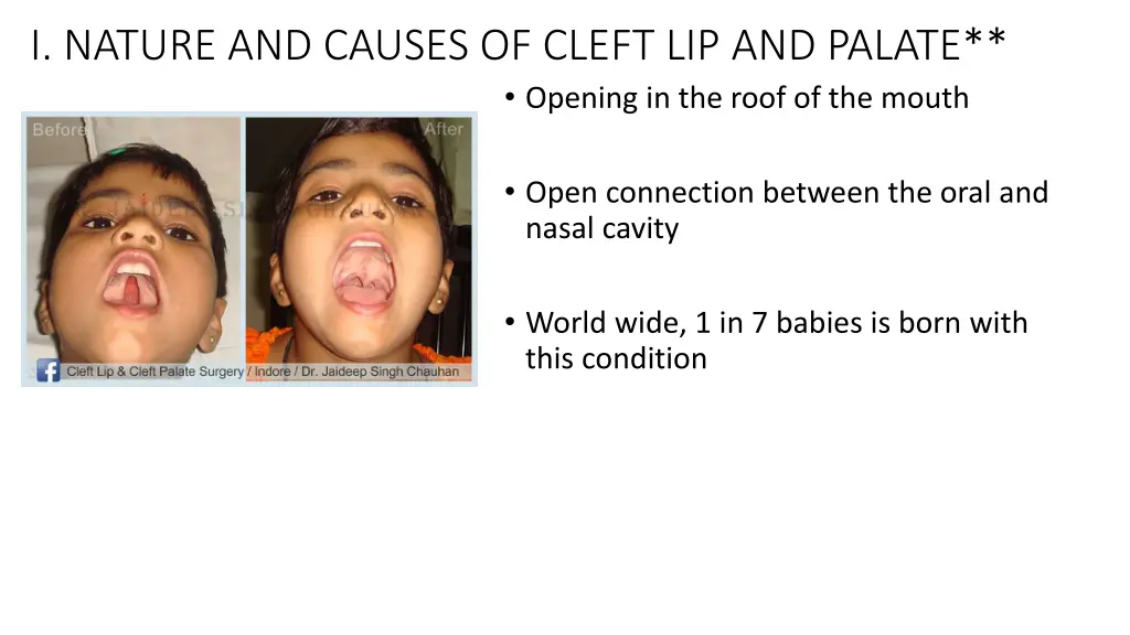 i nature and causes of cleft lip and palate