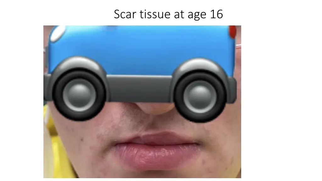 scar tissue at age 16