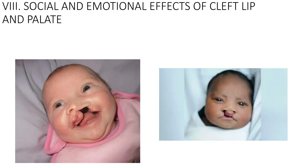 viii social and emotional effects of cleft