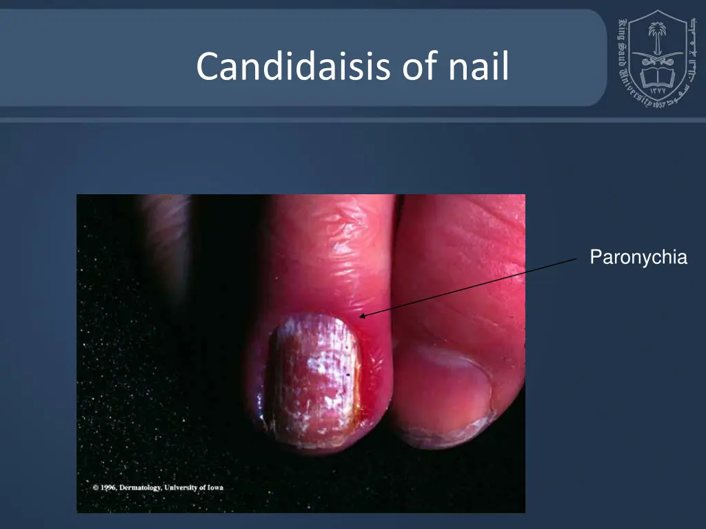 candidaisis of nail