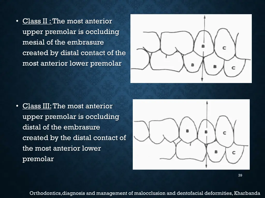 class ii the most anterior upper premolar