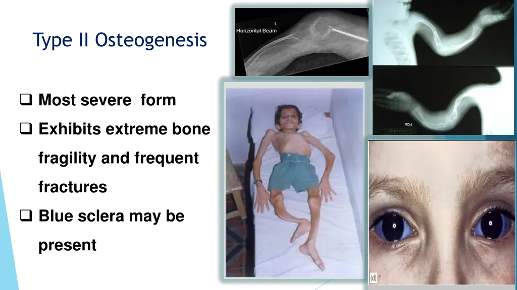type ii osteogenesis