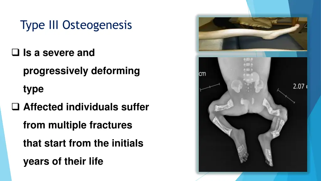 type iii osteogenesis