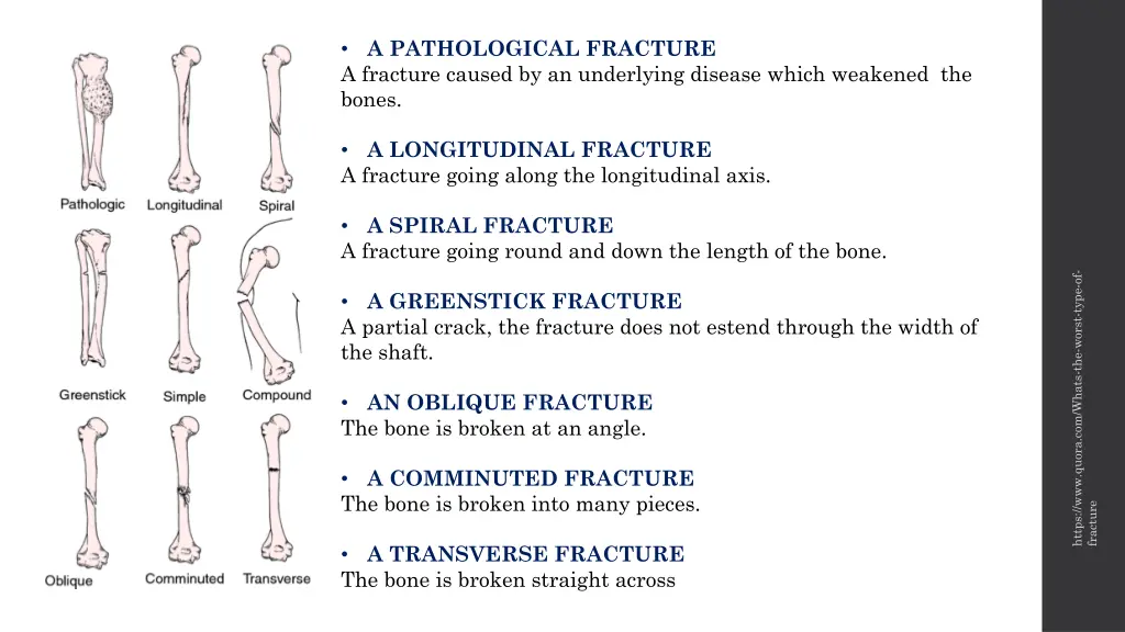 a pathological fracture