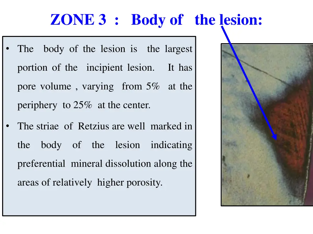 zone 3 body of the lesion