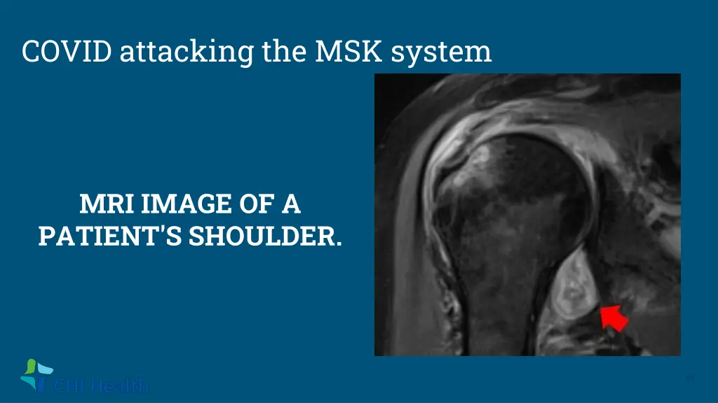 covid attacking the msk system