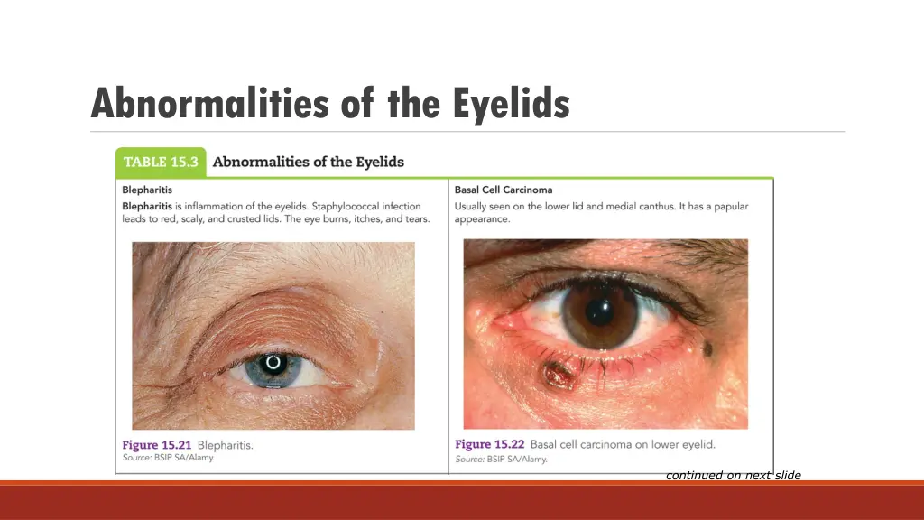 abnormalities of the eyelids