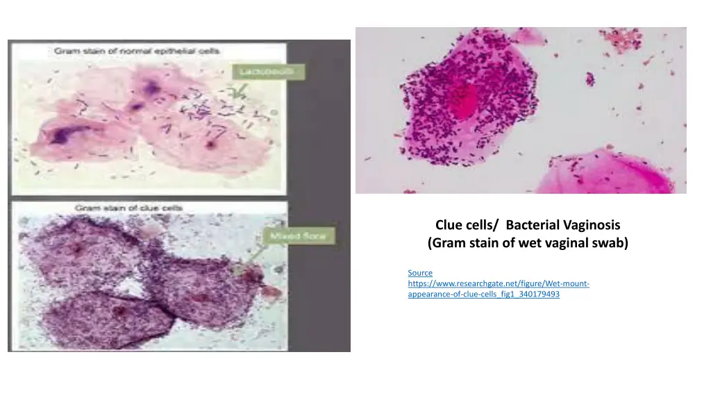 clue cells bacterial vaginosis gram stain
