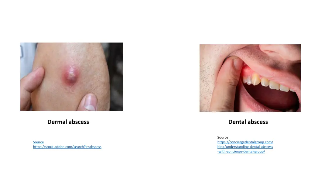 dermal abscess