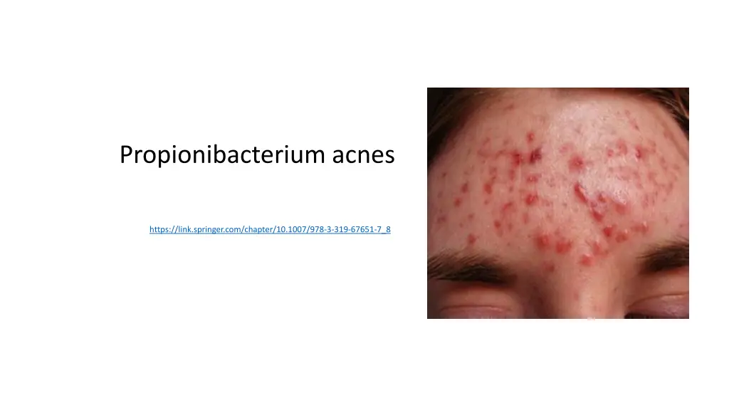 propionibacterium acnes