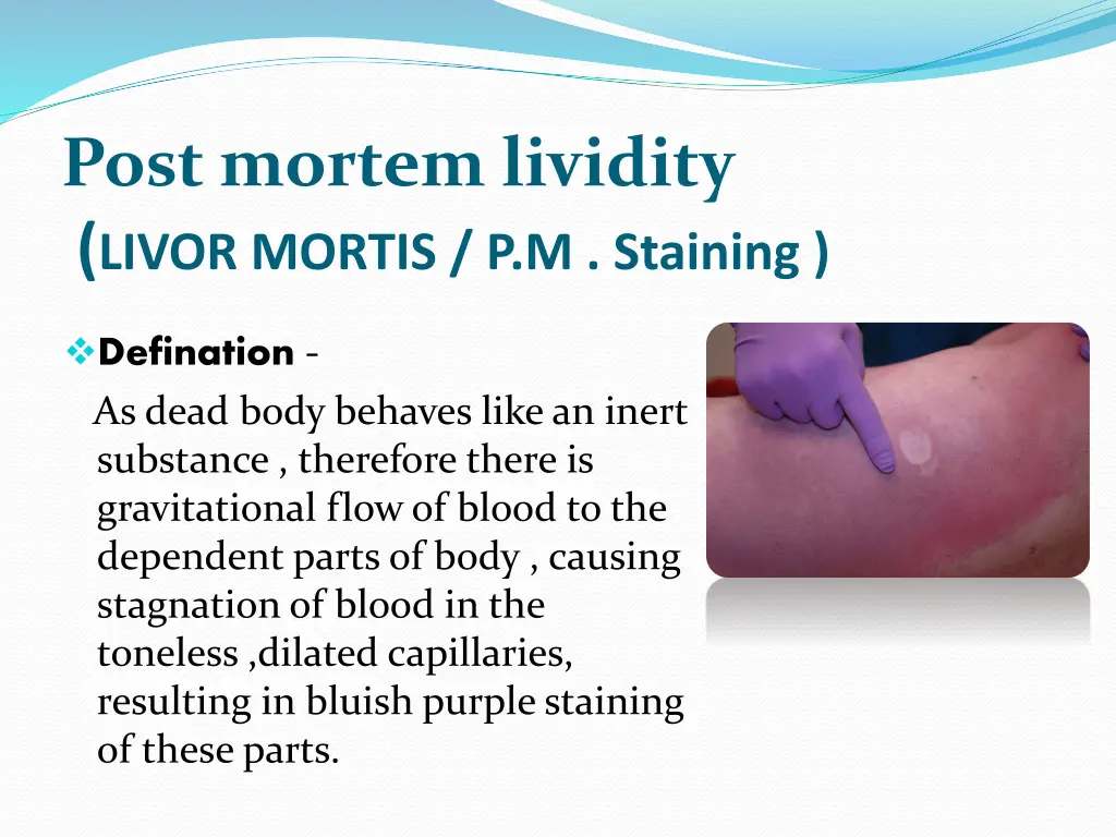 post mortem lividity livor mortis p m staining