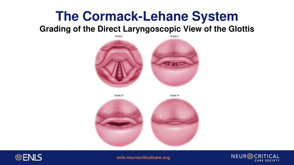 the cormack lehane system grading of the direct