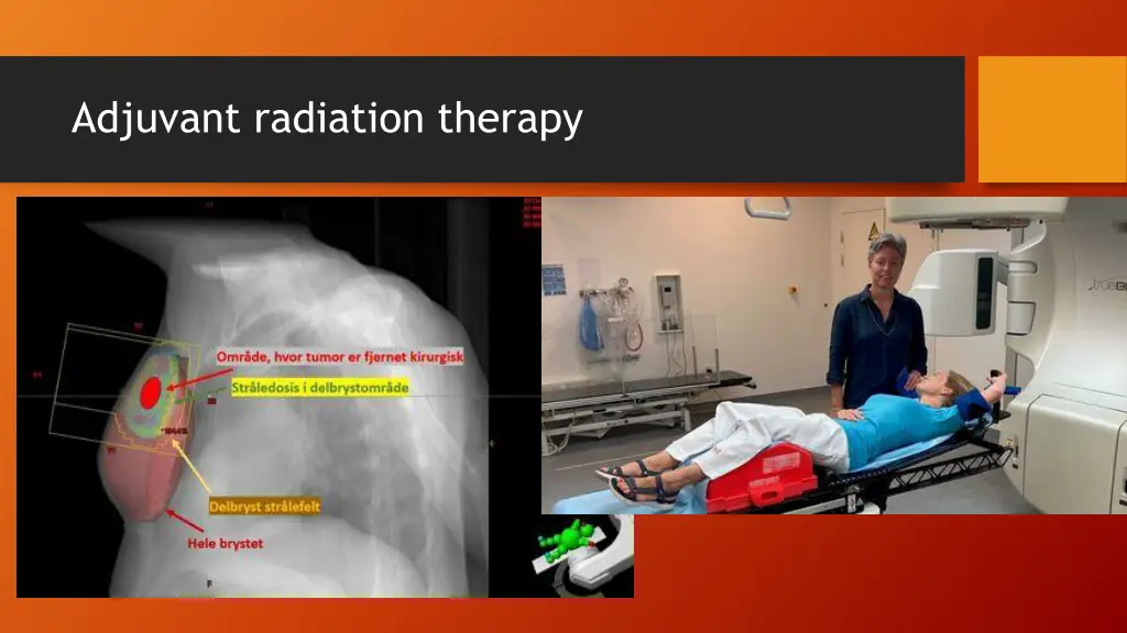 adjuvant radiation therapy