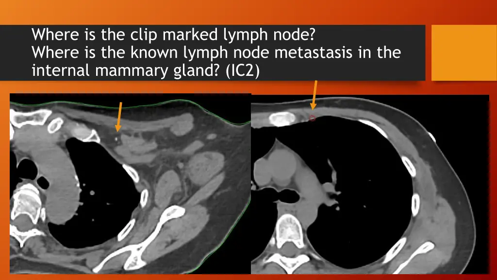 where is the clip marked lymph node where