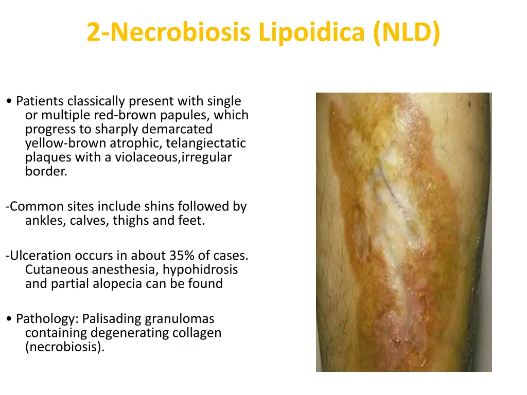 2 necrobiosis lipoidica nld