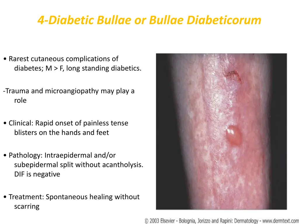 4 diabetic bullae or bullae diabeticorum