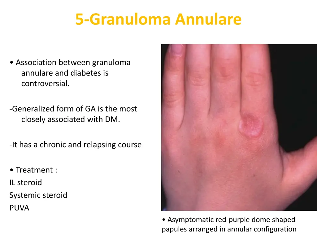 5 granuloma annulare