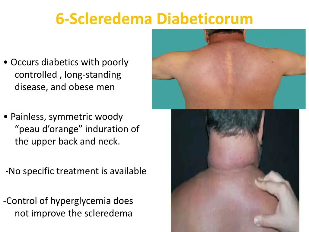 6 scleredema diabeticorum