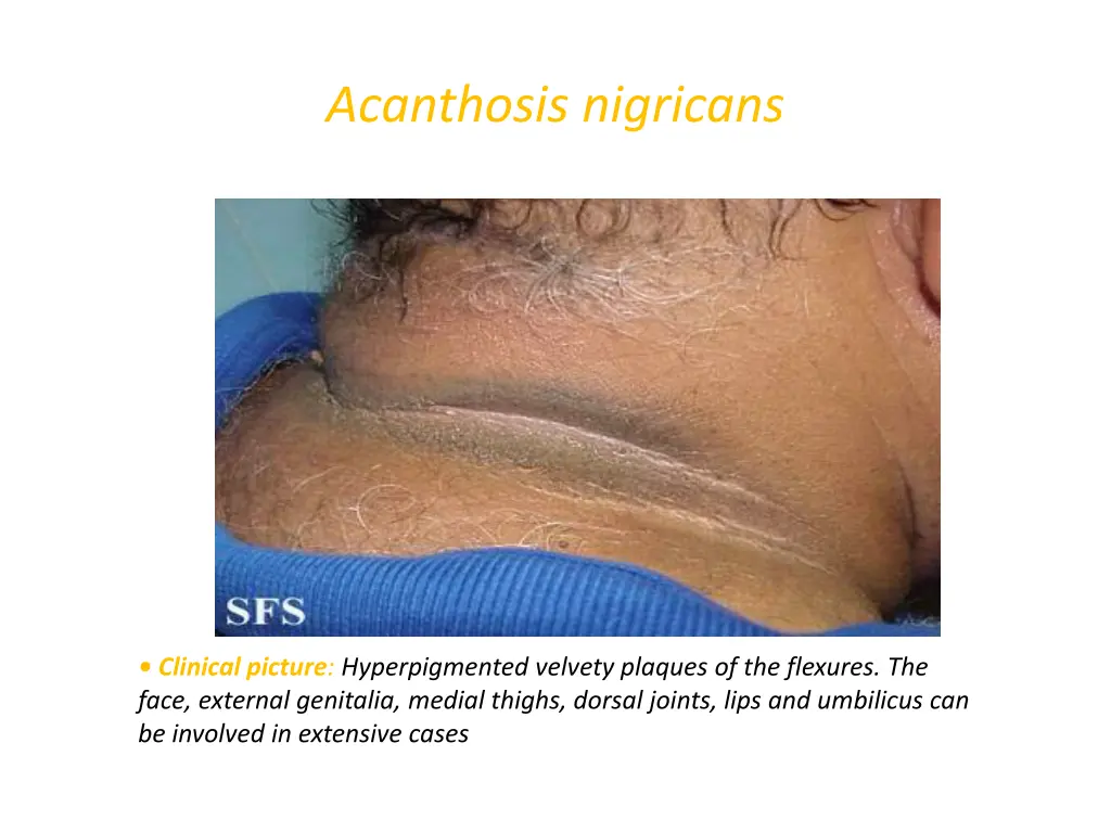 acanthosis nigricans 1