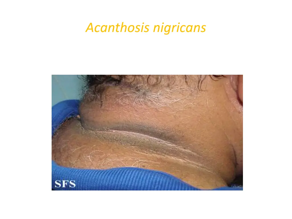 acanthosis nigricans