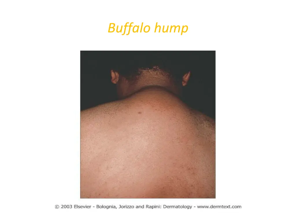 buffalo hump