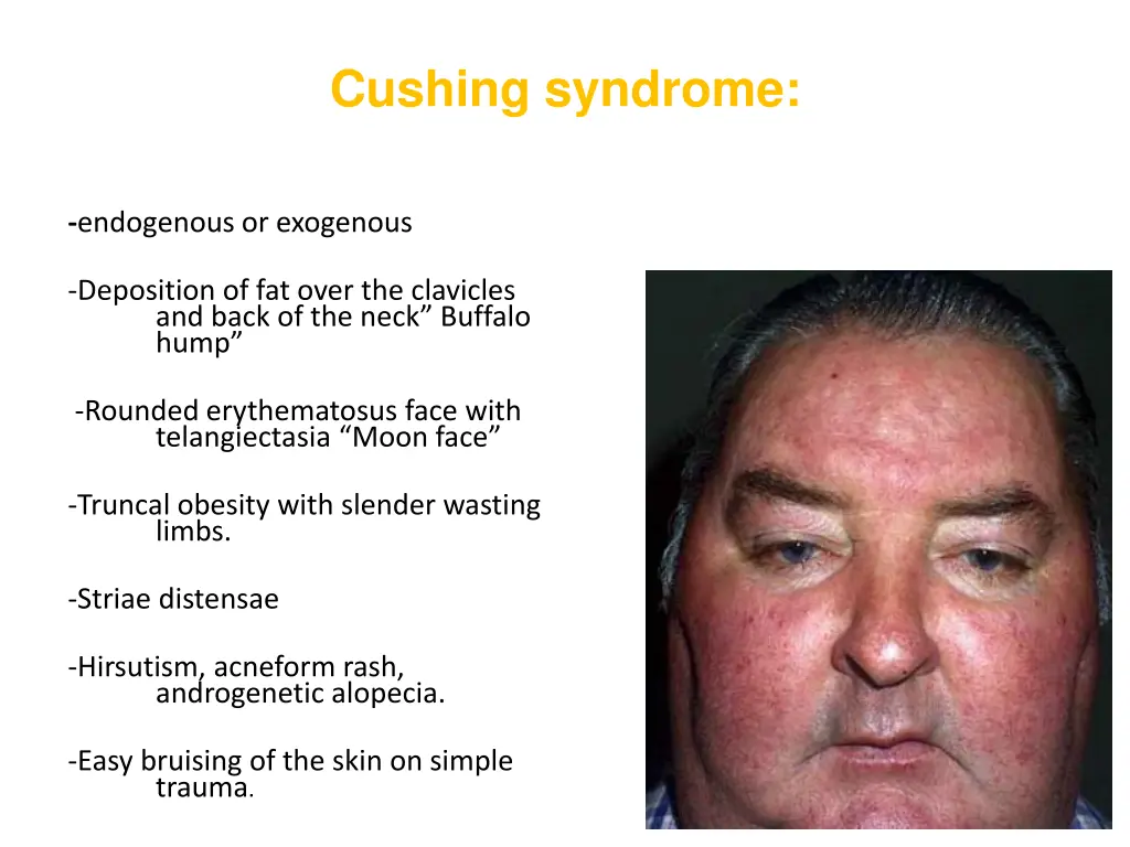 cushing syndrome