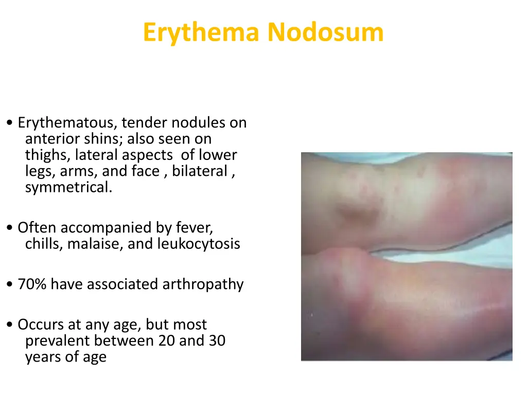 erythema nodosum