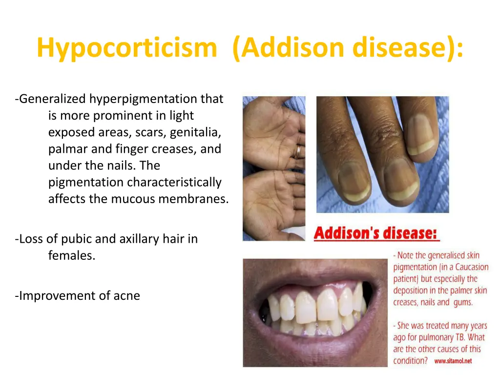 hypocorticism addison disease