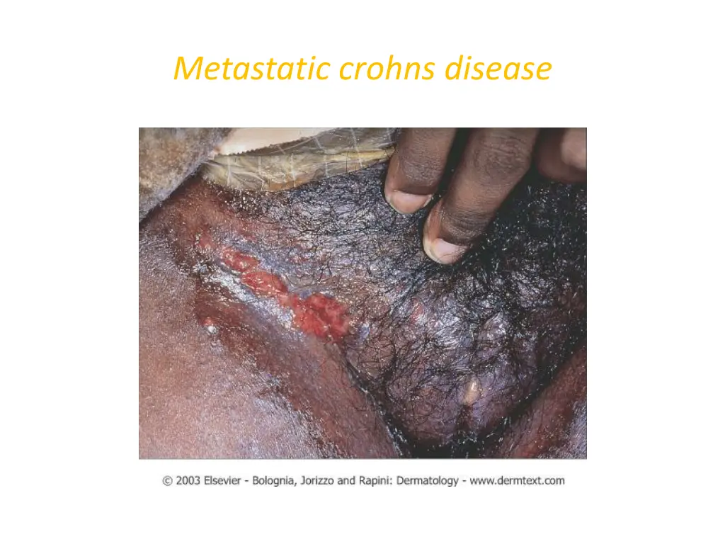 metastatic crohns disease