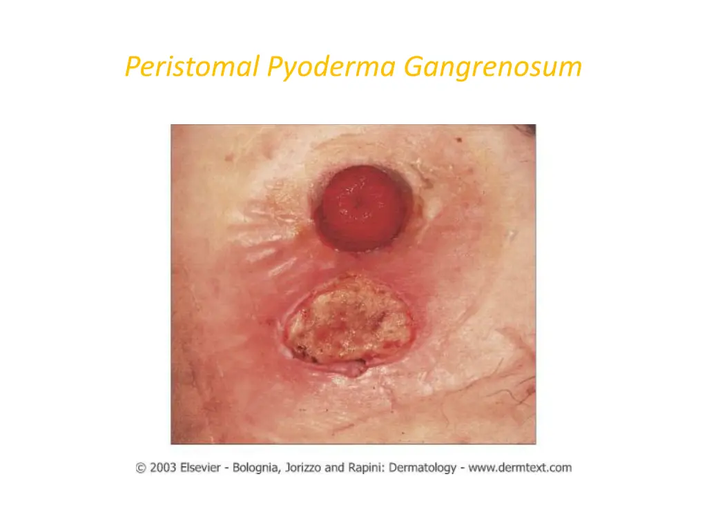 peristomal pyoderma gangrenosum