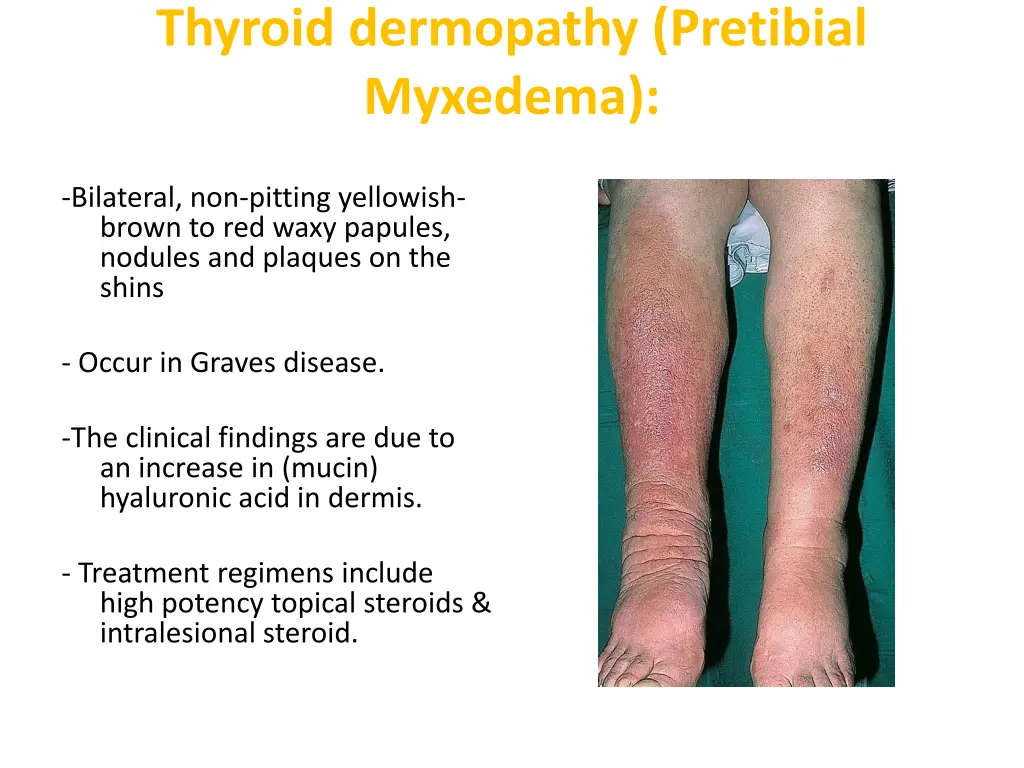 thyroid dermopathy pretibial myxedema