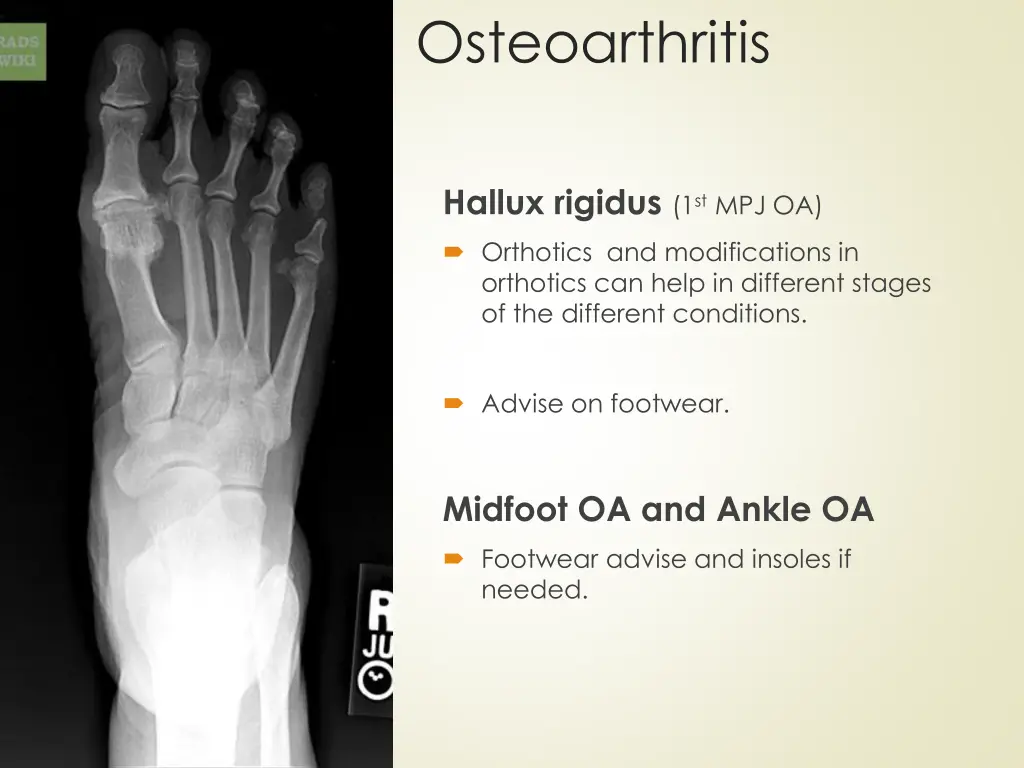 osteoarthritis