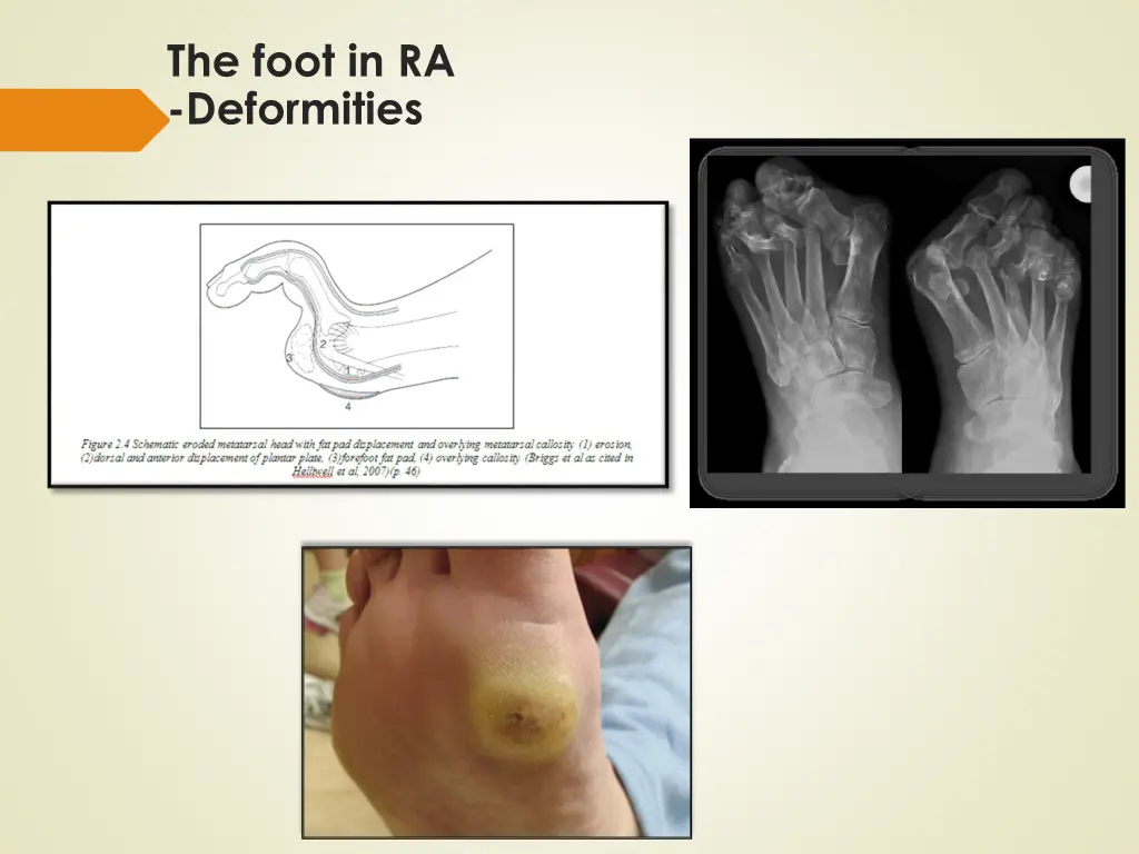 the foot in ra deformities