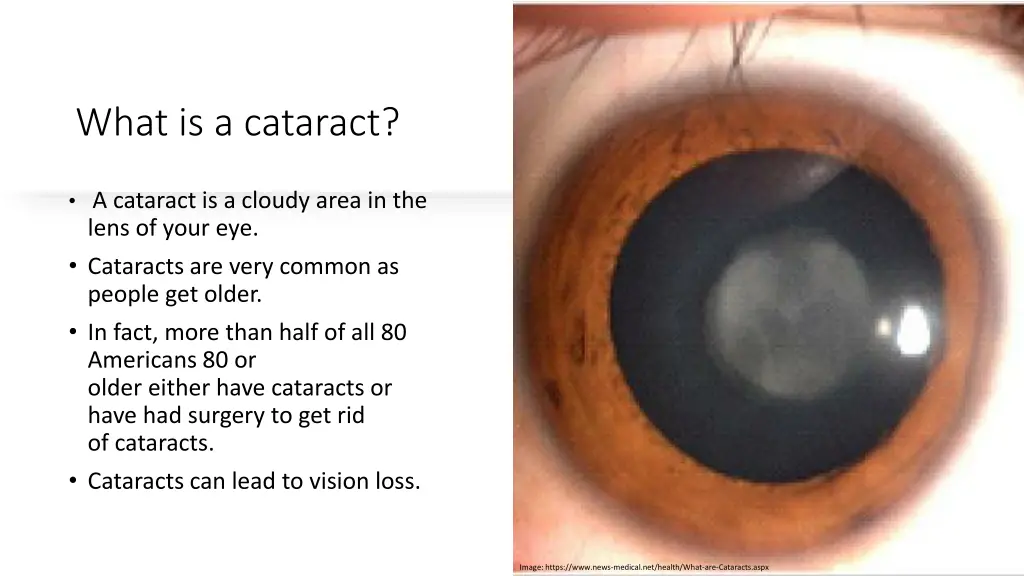 what is a cataract