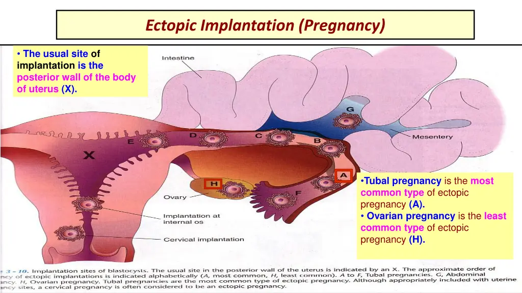 ectopic implantation pregnancy