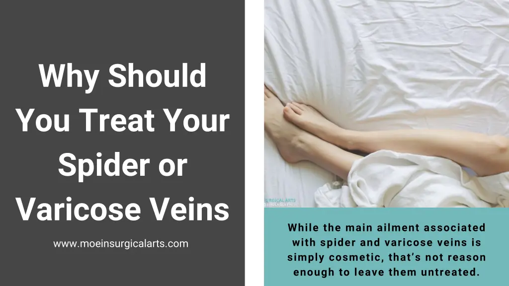 why should you treat your spider or varicose veins